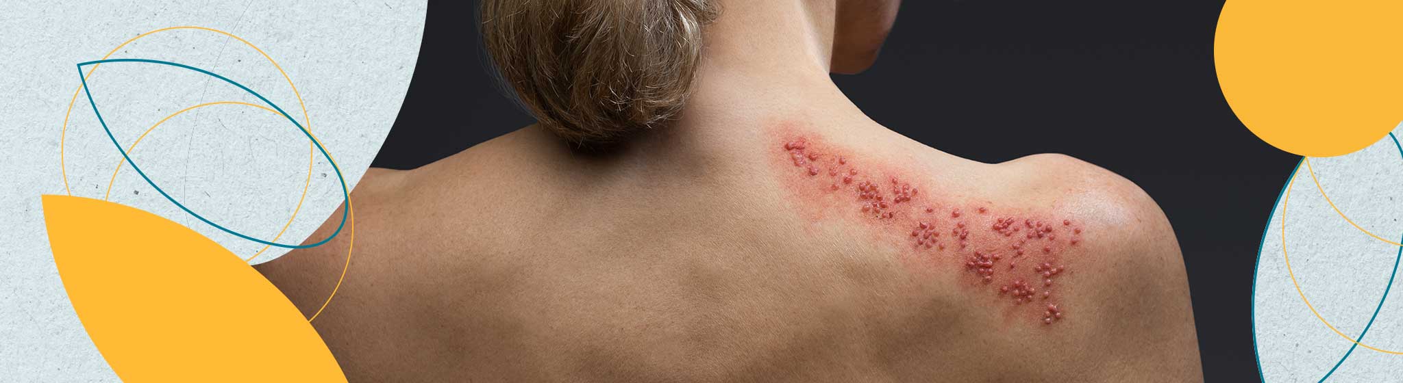 Gürtelrose (Herpes zoster)