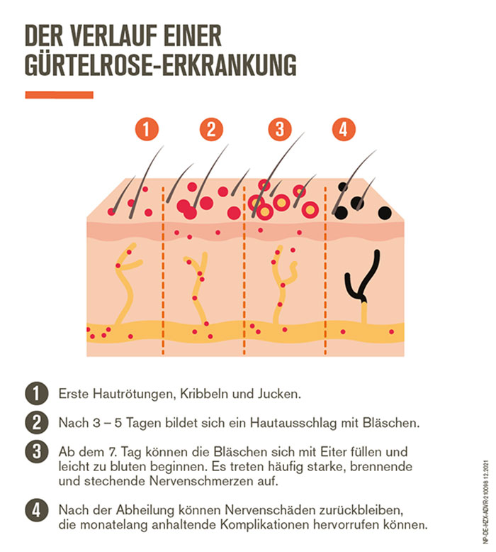210098_211206_Miniadvertorial_Verlauf Verlauf Gürtelrose