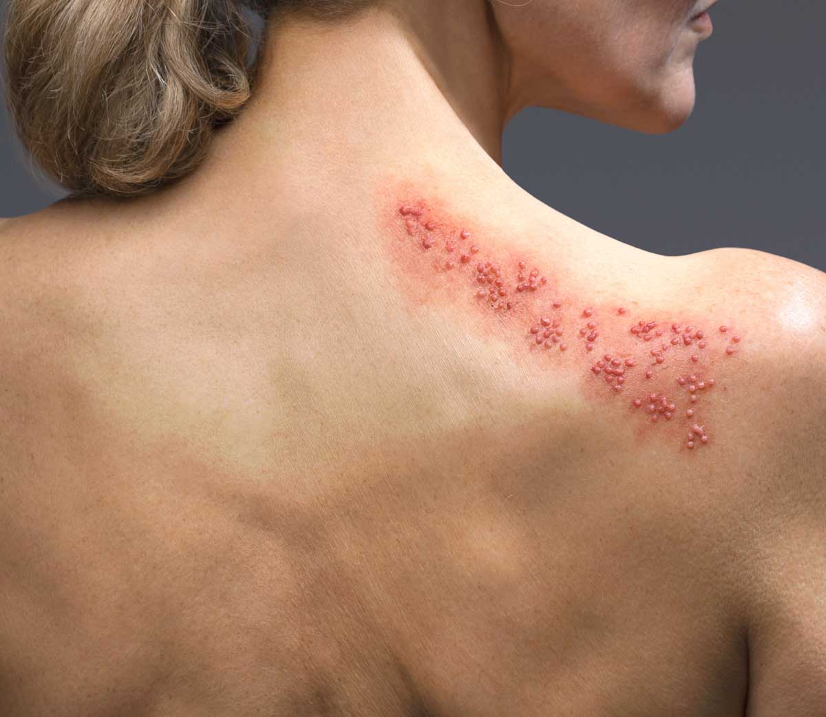 Gürtelrose-Patientin mit Bläschen auf Schulter