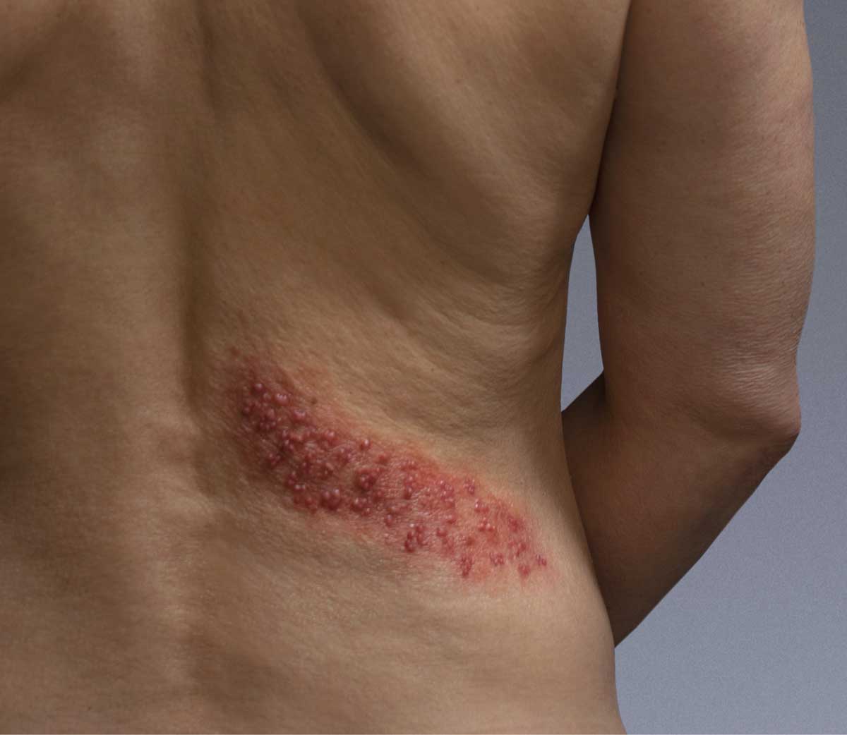Nackter Rücken und rechter Arm einer Frau Anfang 50, Gürtelrose-Bläschen unterer Rücken
