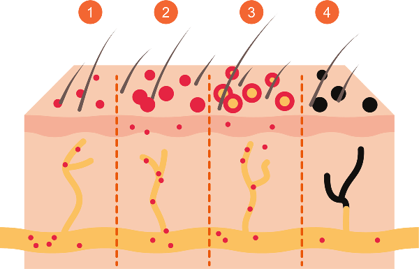 Zeichnung Querschnitt durch Haut, Phasen der Gürtelrose